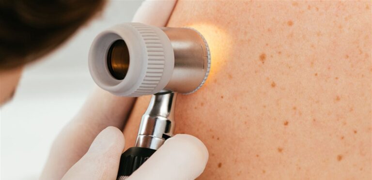 تطبيق يكشف “أخطر سرطانات الجلد”.. اكتشفوا تفاصيل الأمر
